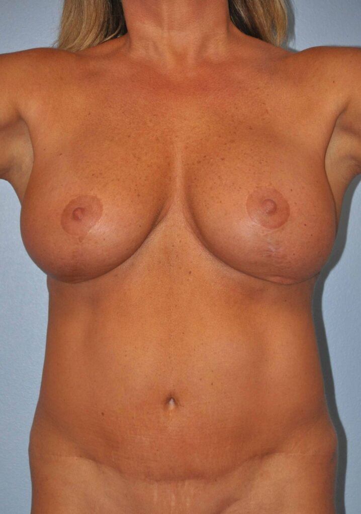Before Image: Breast Implant Exchange with Lift #643 - front