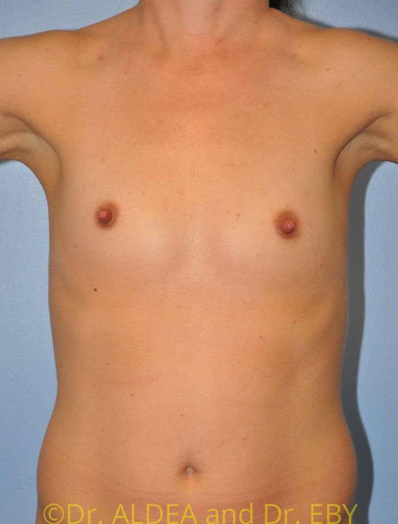 Before Image: Breast Augmentation #638 - front