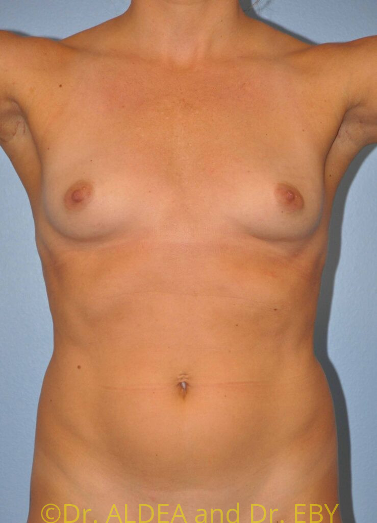Before Image: Breast Augmentation #793 - front