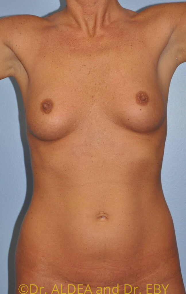 Before Image: Breast Augmentation #887 - front