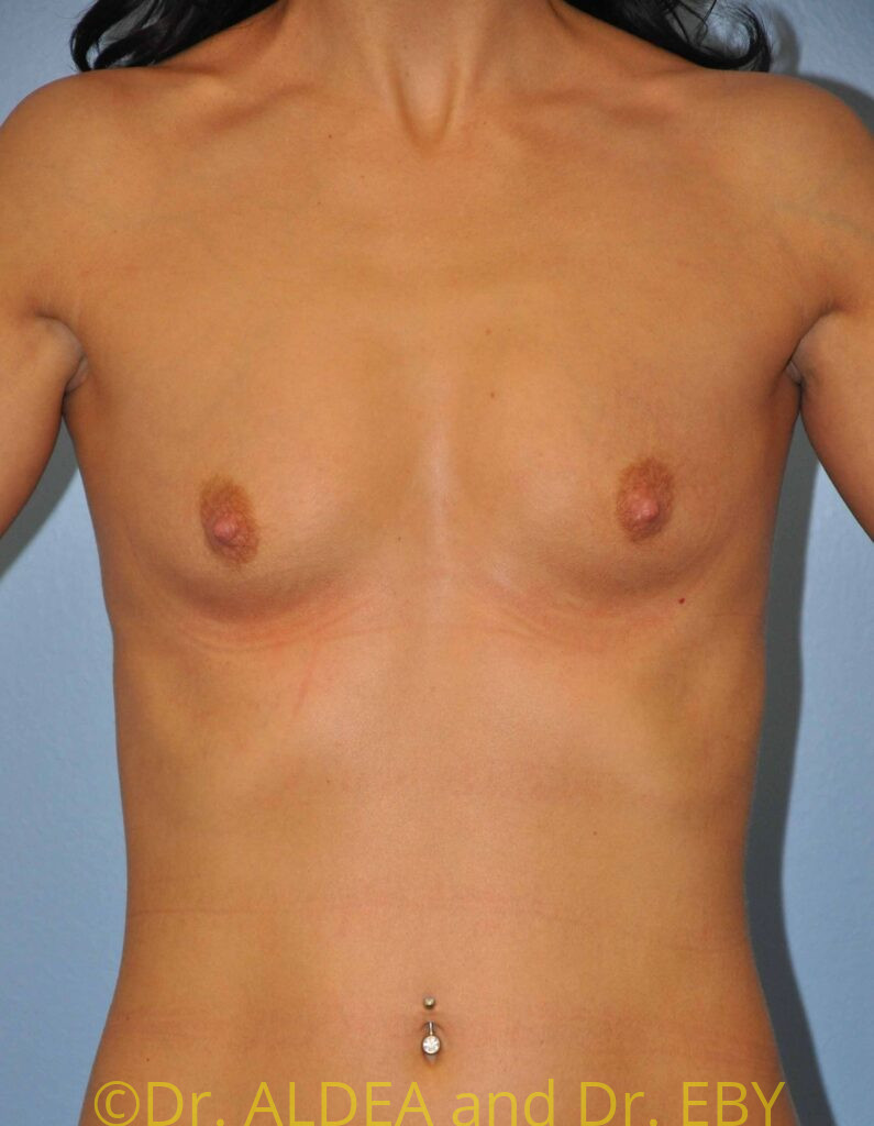 Before Image: Breast Augmentation #917 - front