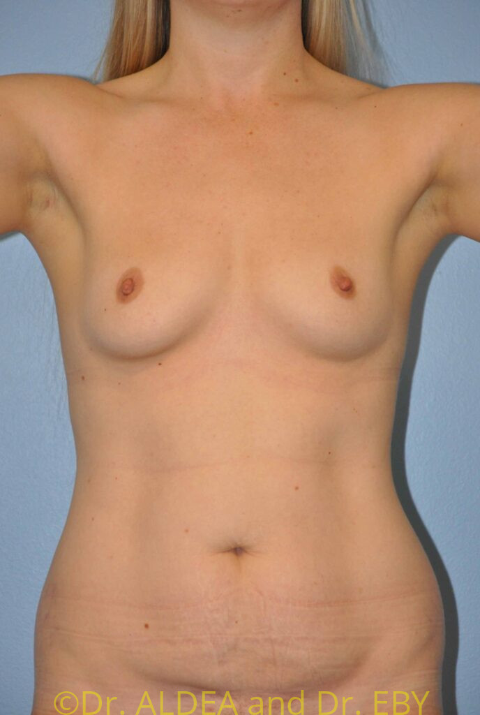 Before Image: Breast Augmentation #129 - front
