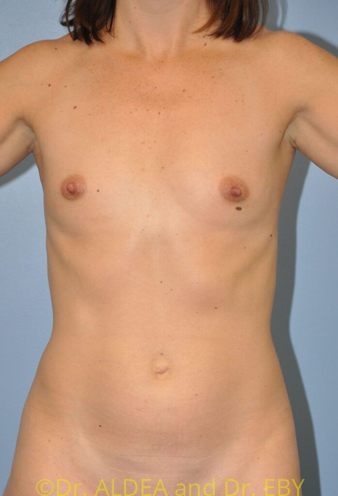 Before Image: Breast Augmentation #719 - front
