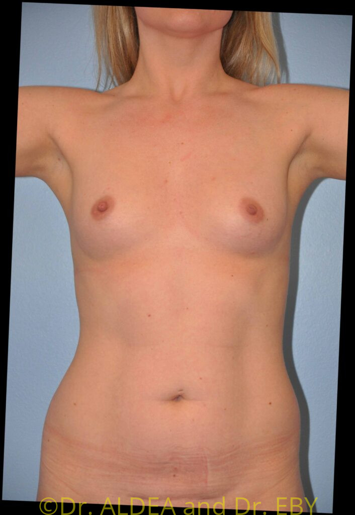 Before Image: Breast Augmentation #972 - front