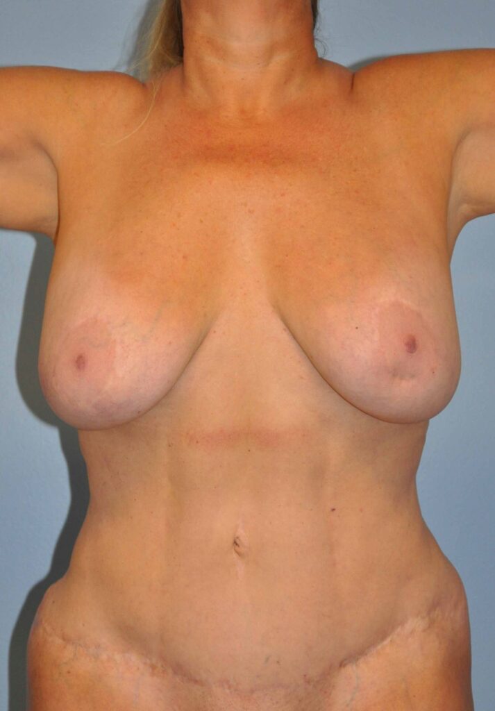 Before Image: Breast Implant Removal (Explantation) WITHOUT Lift #075 - front
