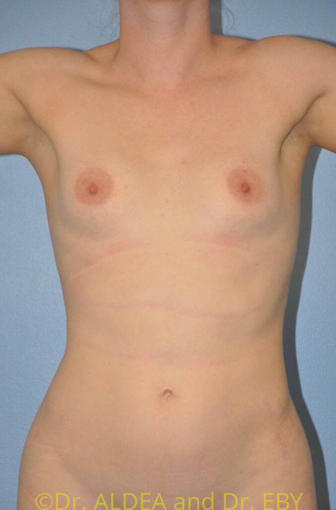Before Image: Breast Augmentation #913 - front