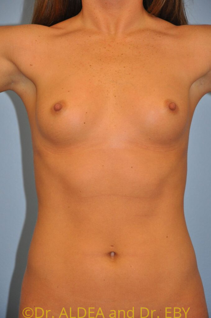 Before Image: Breast Augmentation #960 - front
