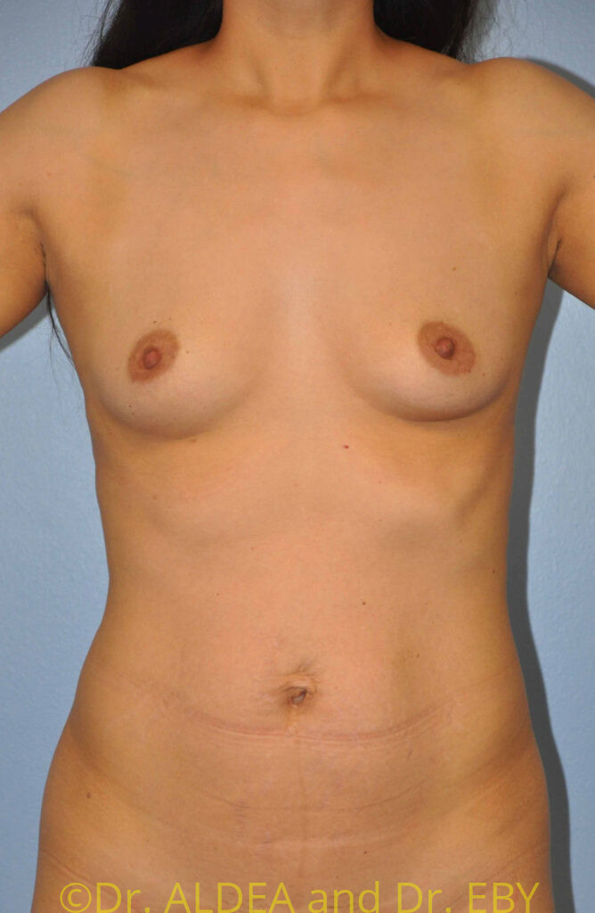 Before Image: Breast Augmentation #263 - front