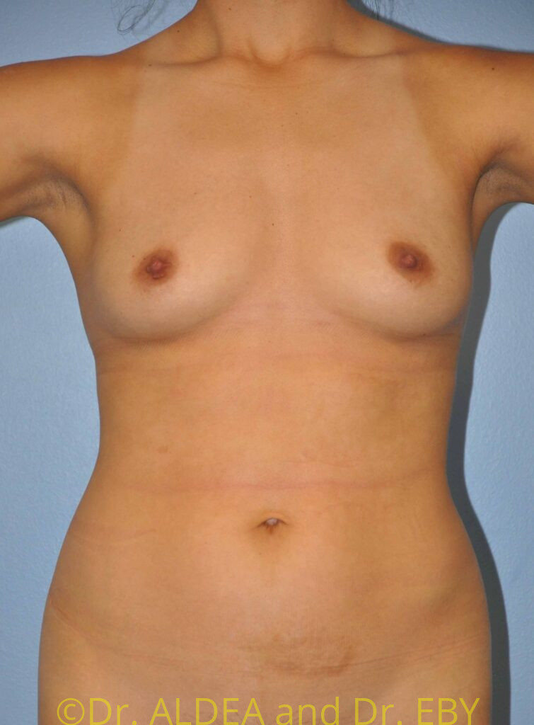 Before Image: Breast Augmentation #193 - front