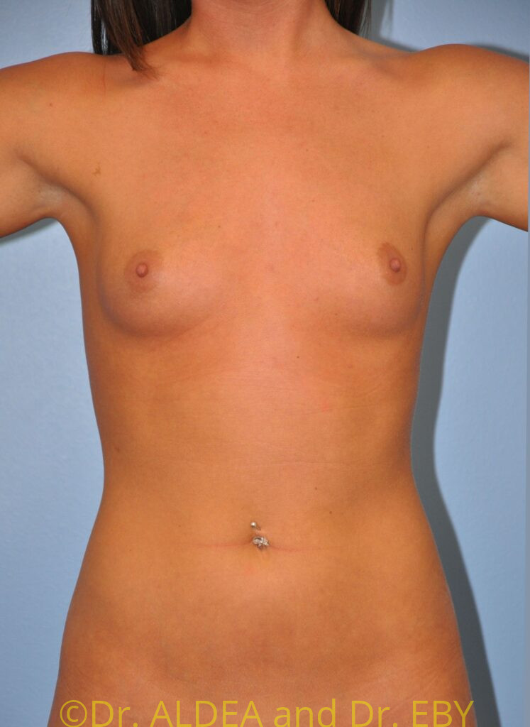 Before Image: Breast Augmentation #291 - front