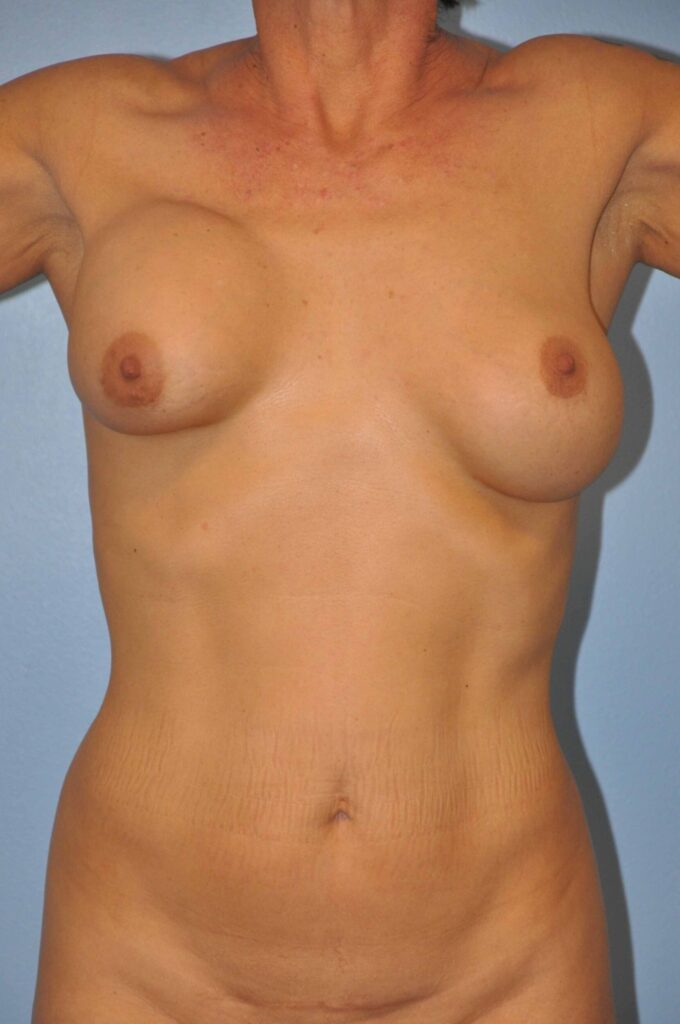 Before Image: Breast Implant Exchange with Lift #578 - front