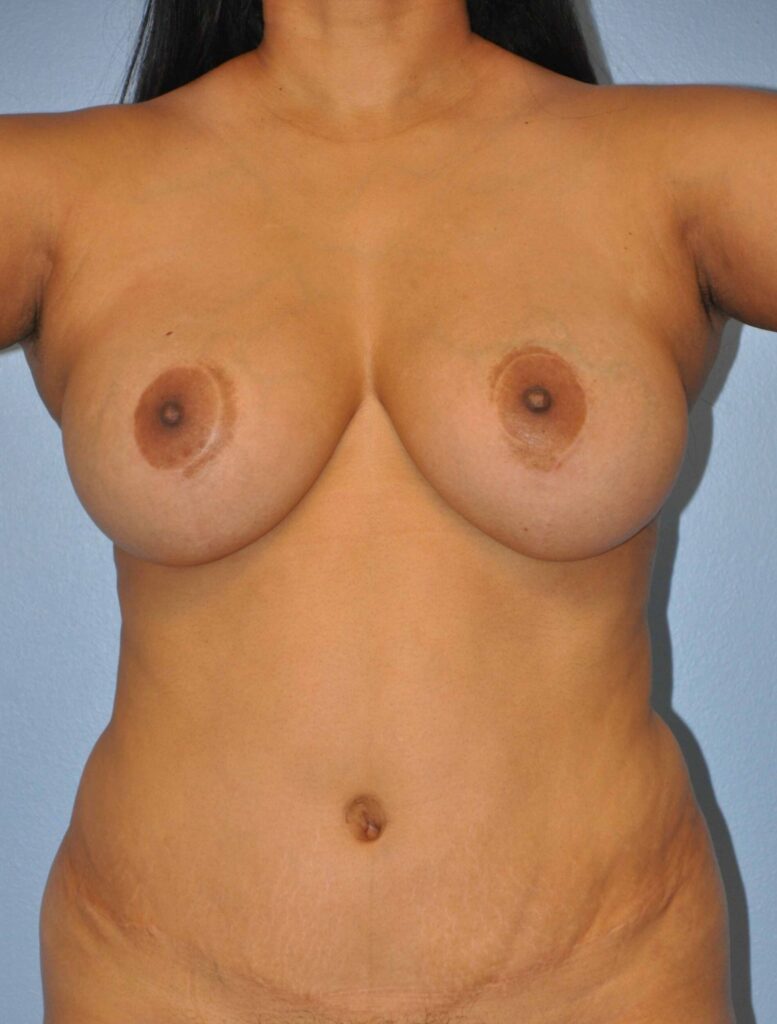 Before Image: Breast Implant Removal (Explantation) WITHOUT Lift #488 - front