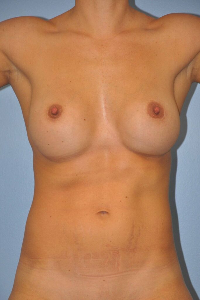 Before Image: Breast Implant Exchange #444 - front
