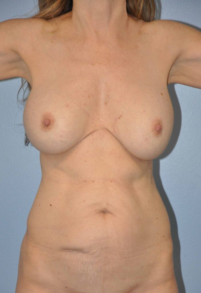 Before Image: Breast Implant Removal (Explantation) WITH a Lift #117 - front
