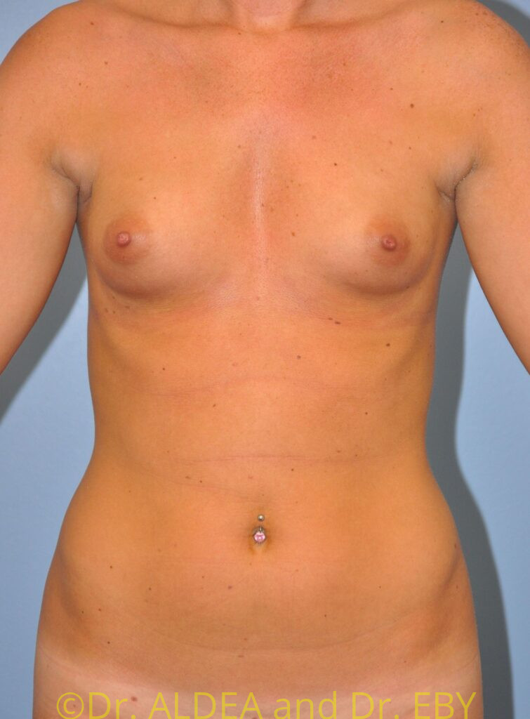 Before Image: Breast Augmentation #210 - front