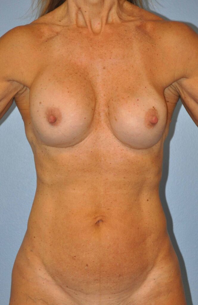 Before Image: Breast Implant Exchange with Lift #971 - front