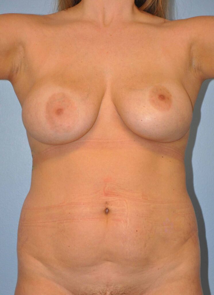 Before Image: Breast Implant Removal (Explantation) WITH a Lift #334 - front