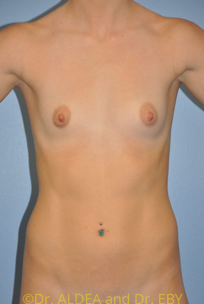 Before Image: Breast Augmentation #292 - front