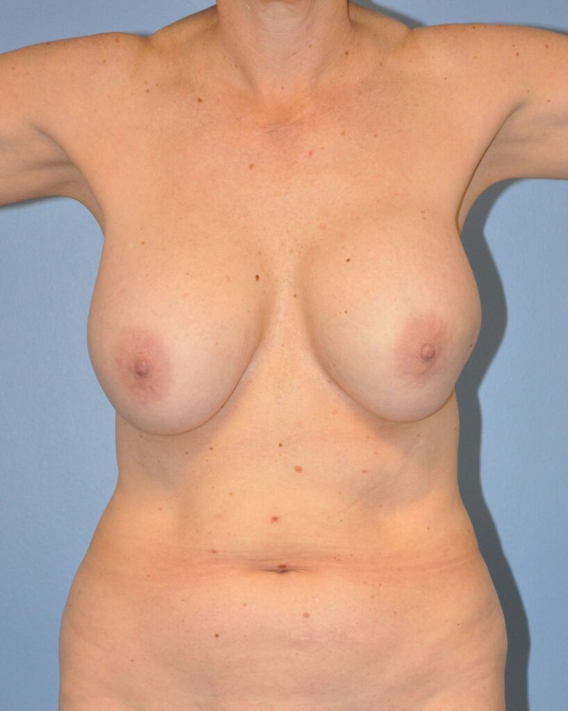 Before Image: Breast Implant Removal (Explantation) WITH a Lift #963 - front
