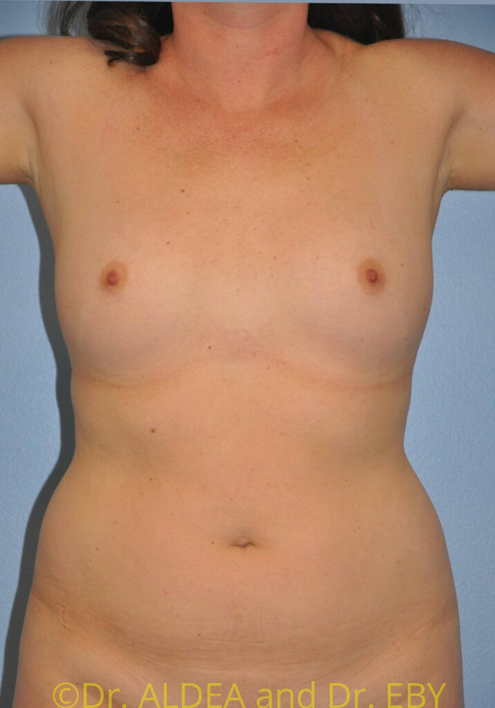 Before Image: Breast Augmentation #413 - front