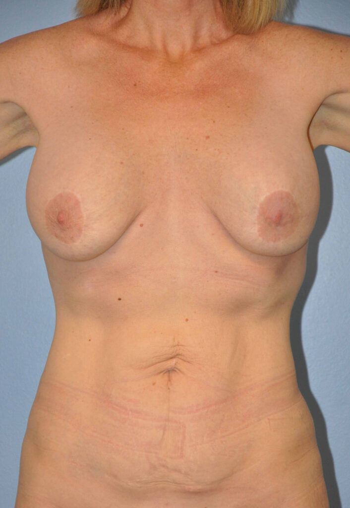 Before Image: Breast Implant Exchange with Lift #380 - front