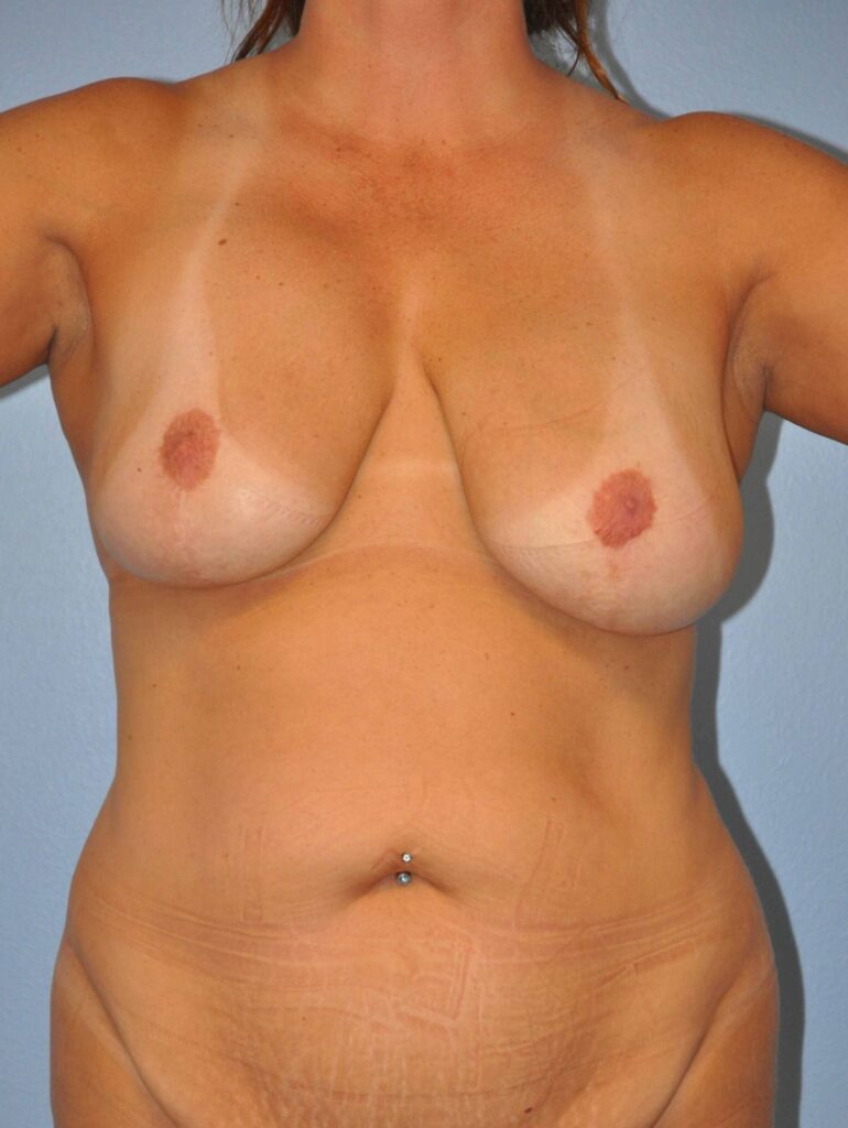 Before Image: Breast Implant Removal (Explantation) WITH a Lift #927 - front