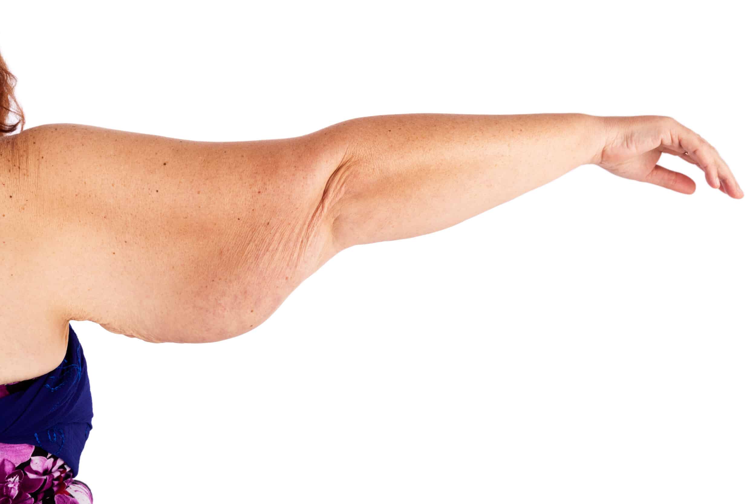 Dr-Aldea-Brachioplasty-_1205979907