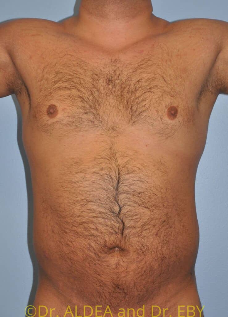 Before Image: Gynecomastia #905 - front