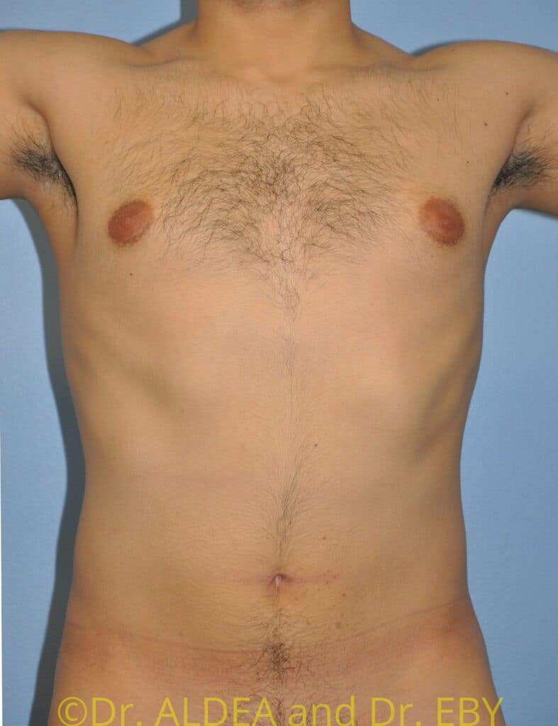 Before Image: Gynecomastia #808 - front