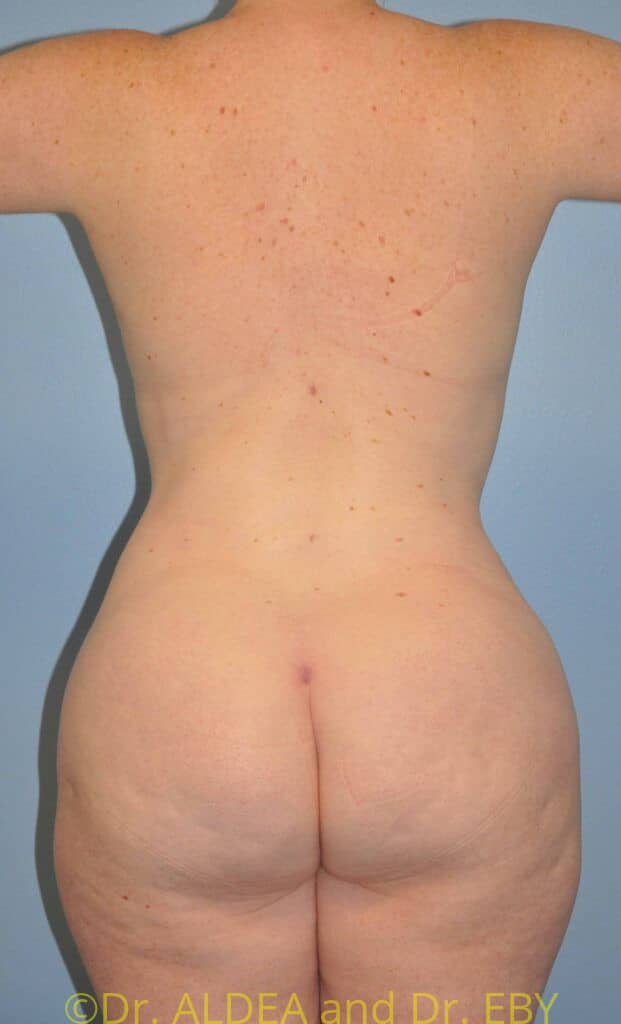 After Image: Back Scoop Liposuction #462 - back