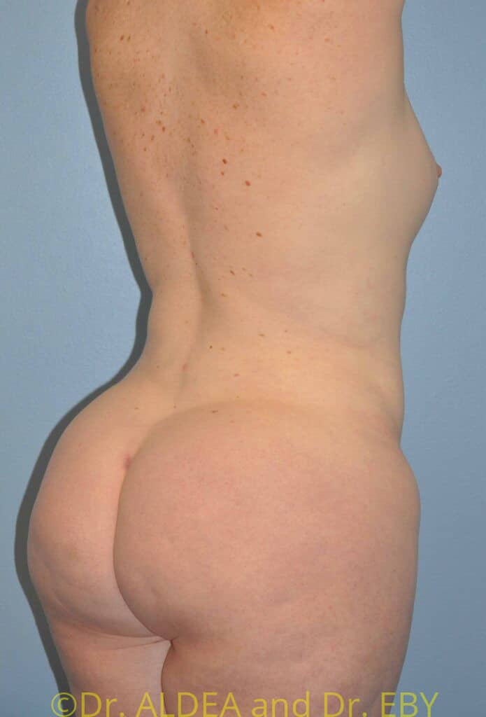 After Image: Back Scoop Liposuction #462 - right-back-oblique