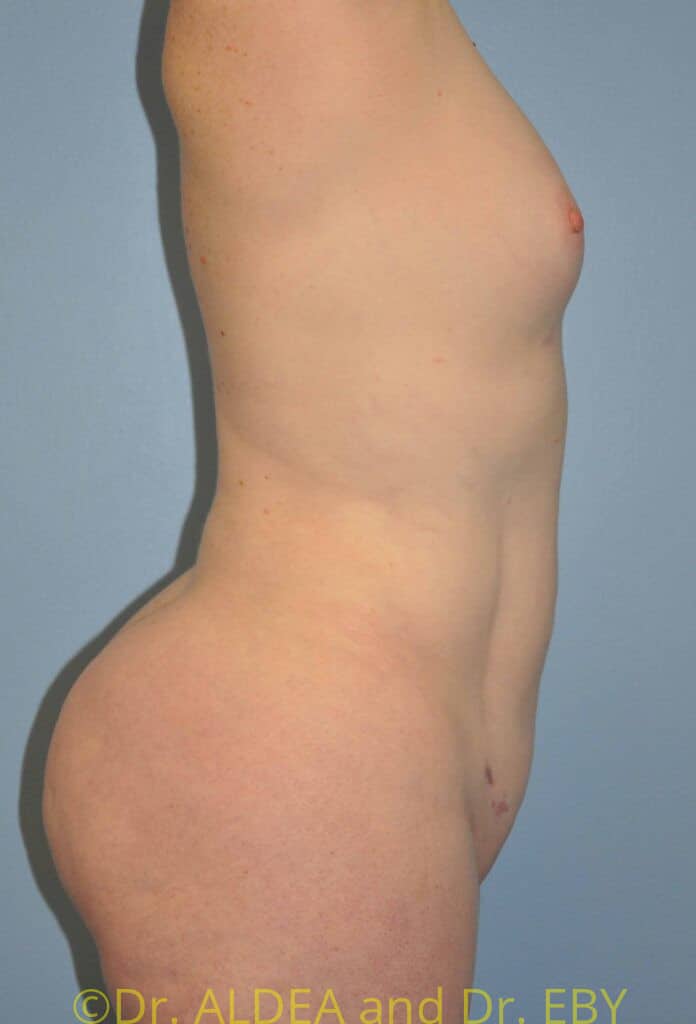 After Image: Back Scoop Liposuction #462 - right-side