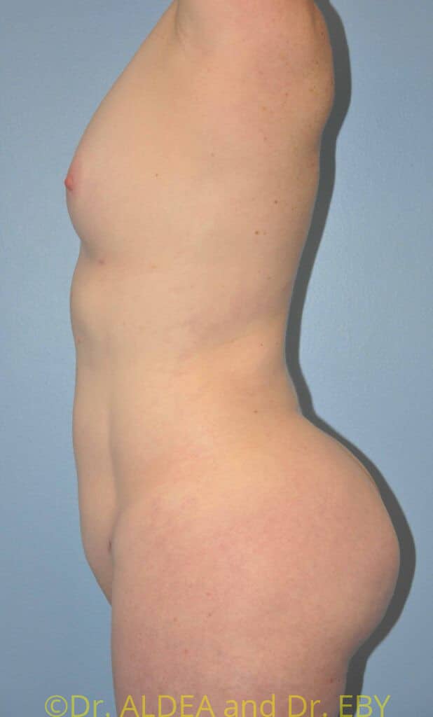 After Image: Back Scoop Liposuction #462 - left-side
