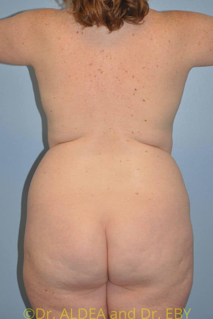 Before Image: Back Scoop Liposuction #462 - back