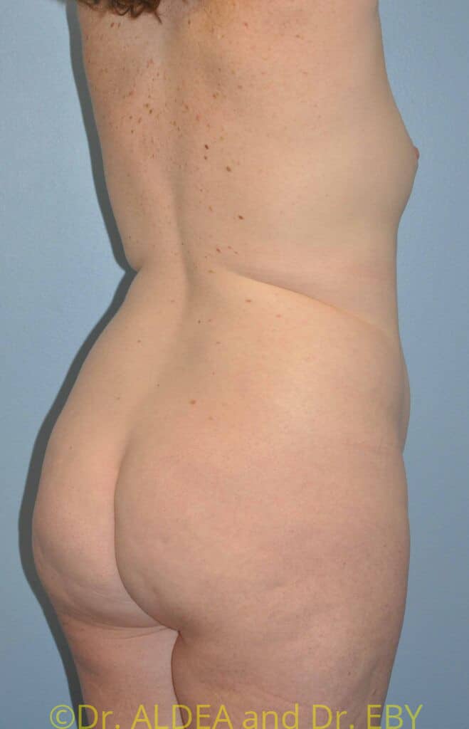 Before Image: Back Scoop Liposuction #462 - right-back-oblique
