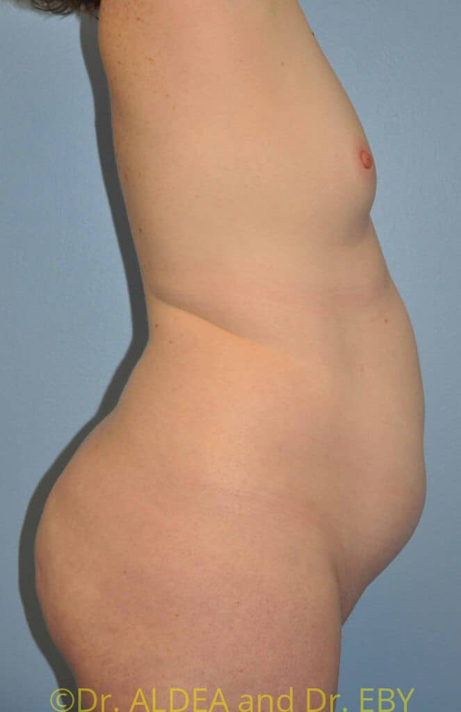 Before Image: Back Scoop Liposuction #462 - right-side