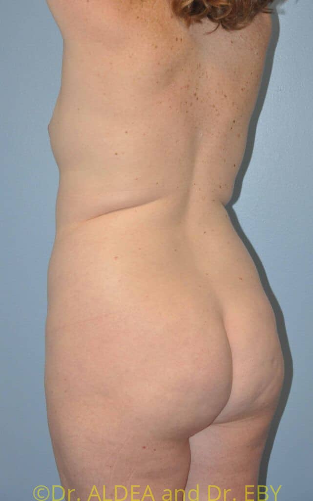 Before Image: Back Scoop Liposuction #462 - left-back-oblique