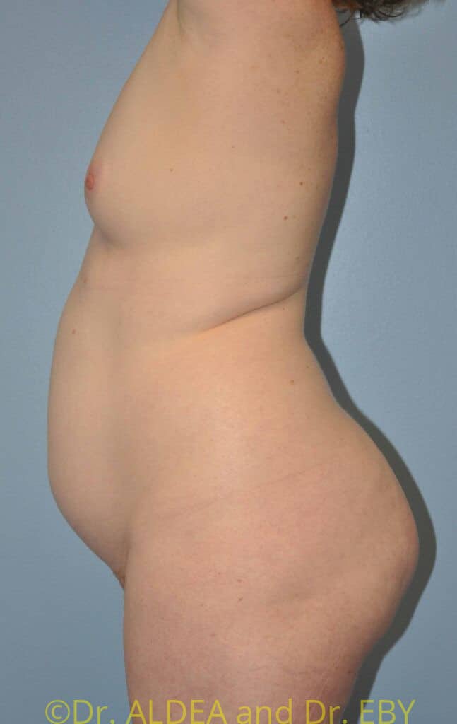 Before Image: Back Scoop Liposuction #462 - left-side