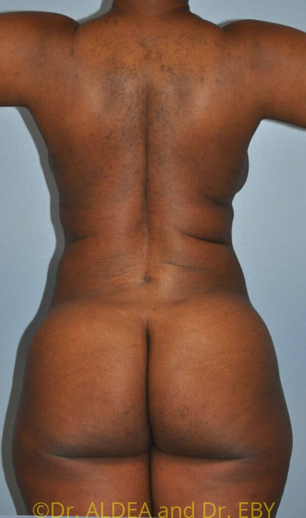 After Image: Back Scoop Liposuction #699 - back
