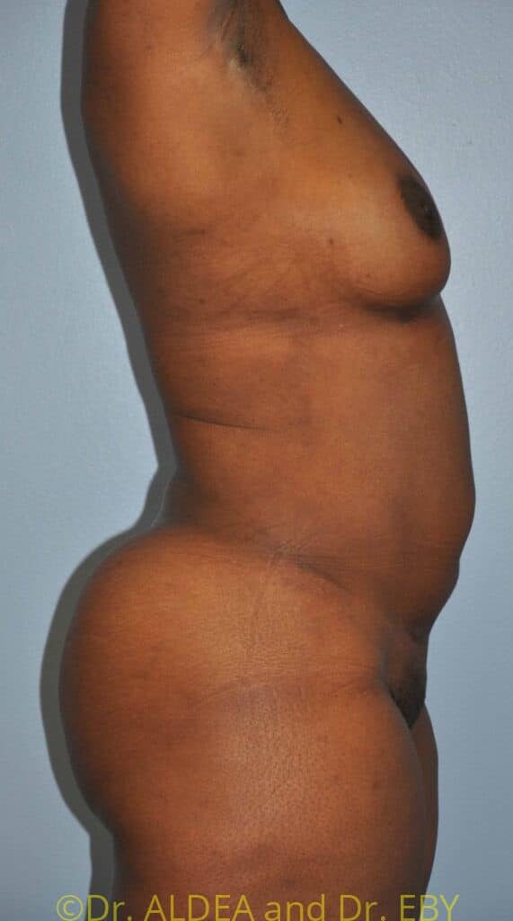 After Image: Back Scoop Liposuction #699 - right-side