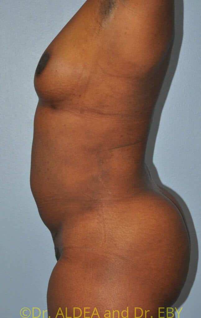 After Image: Back Scoop Liposuction #699 - left-side