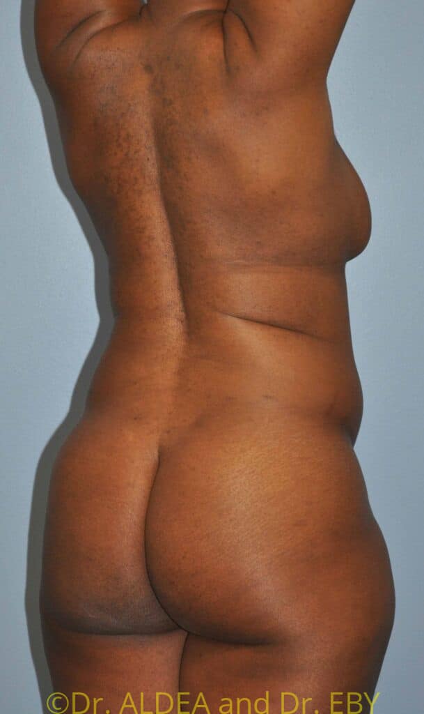 Before Image: Back Scoop Liposuction #699 - right-back-oblique