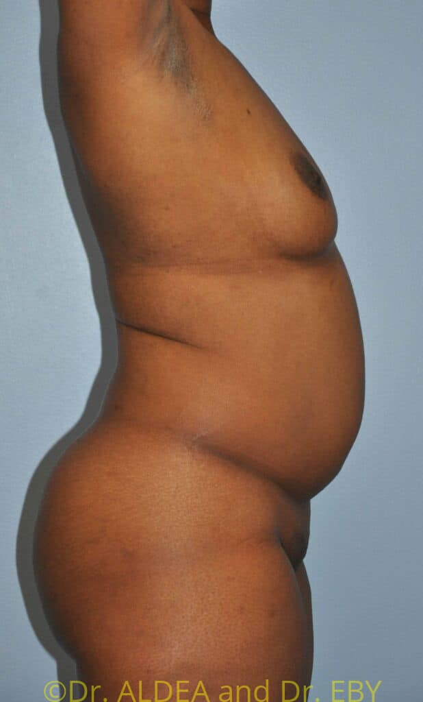 Before Image: Back Scoop Liposuction #699 - right-side