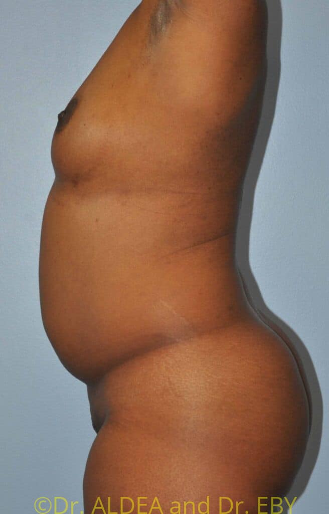 Before Image: Back Scoop Liposuction #699 - left-side