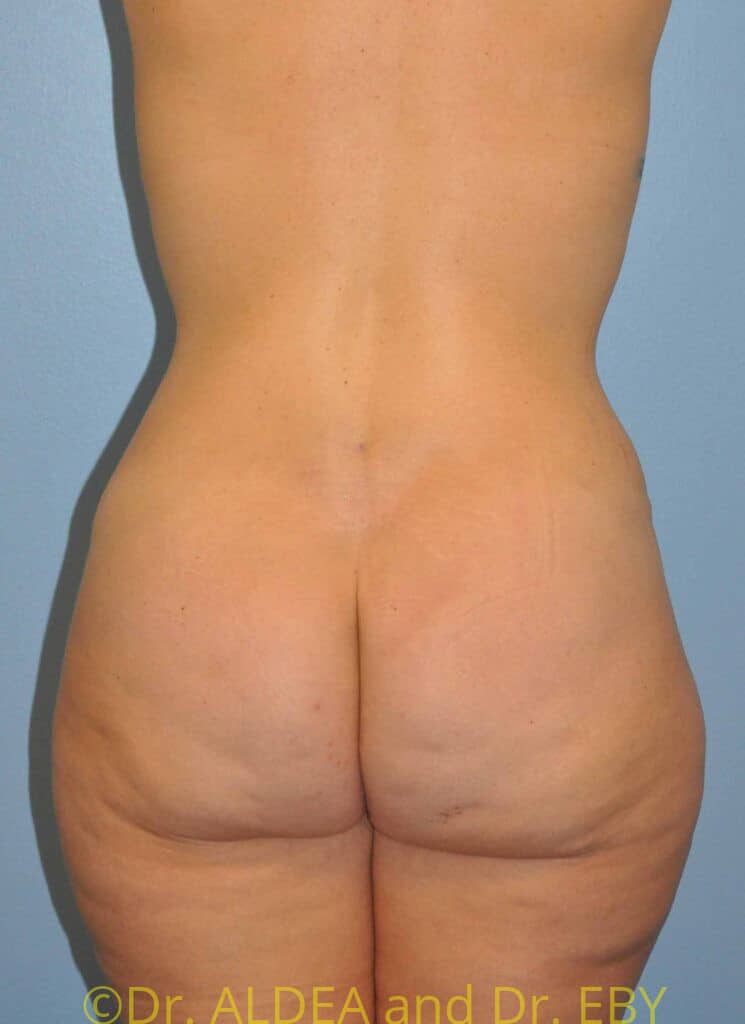 After Image: Back Scoop Liposuction #765 - back