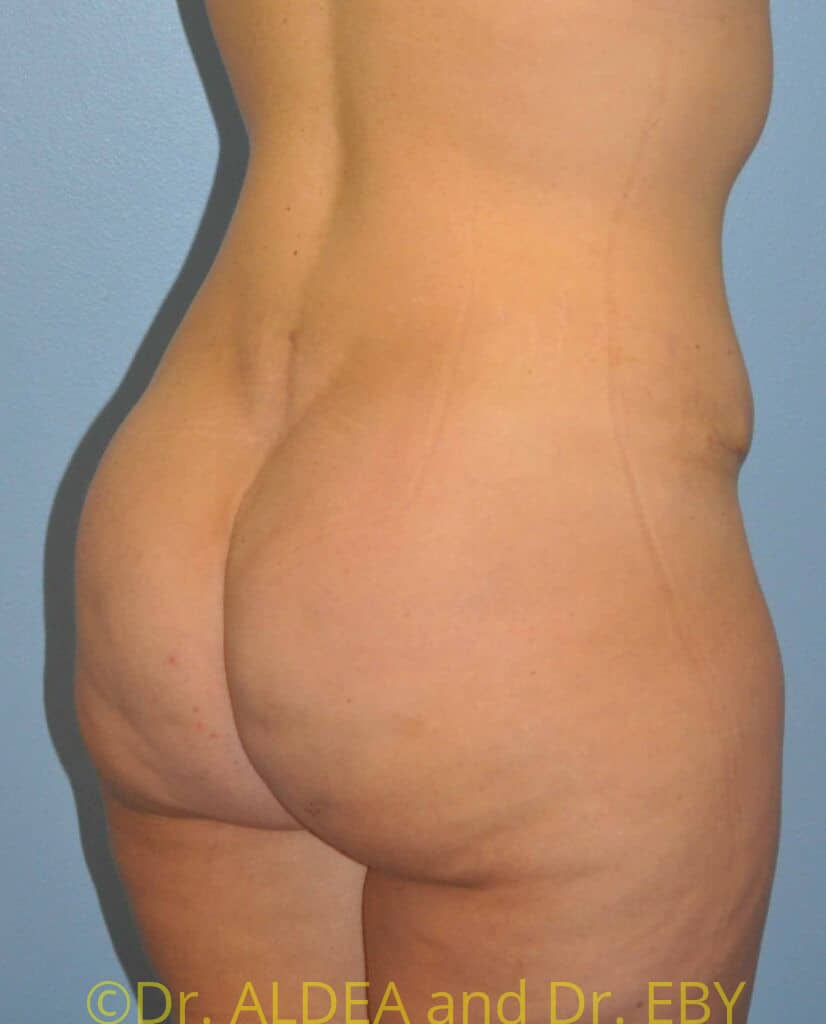 After Image: Back Scoop Liposuction #765 - right-back-oblique