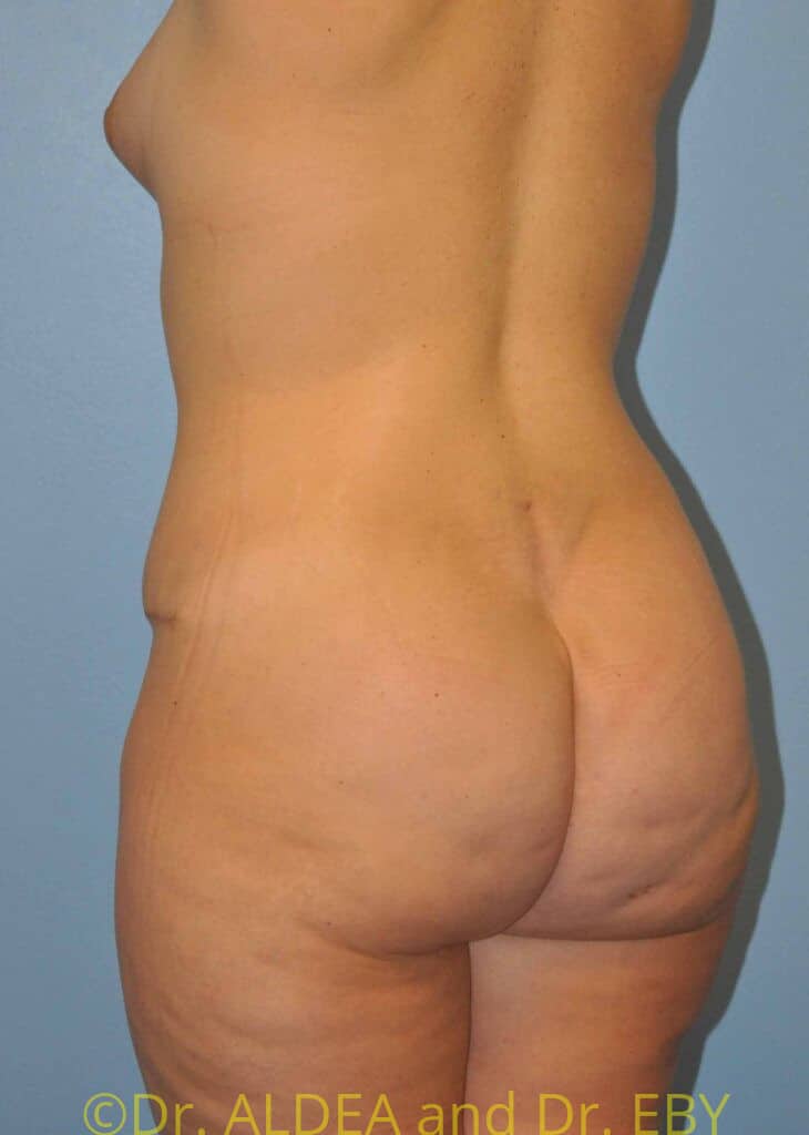 After Image: Back Scoop Liposuction #765 - left-back-oblique