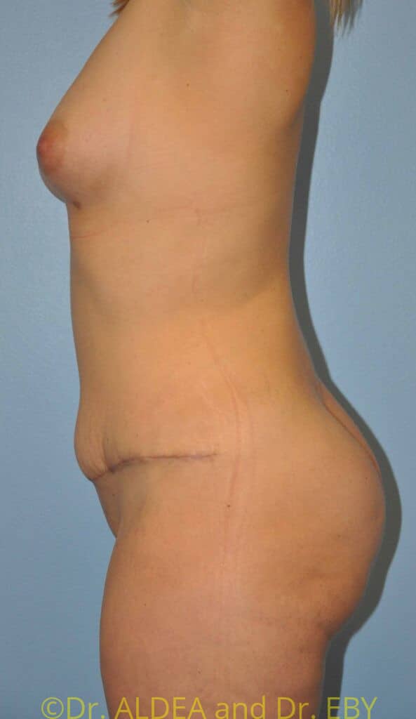 After Image: Back Scoop Liposuction #765 - left-side