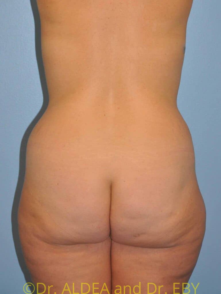 Before Image: Back Scoop Liposuction #765 - back