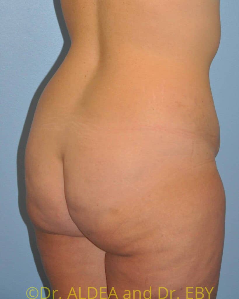 Before Image: Back Scoop Liposuction #765 - right-back-oblique